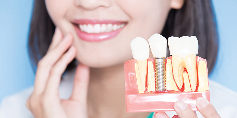 Rediscover Your Smile with Dental Implants at Family Dental Center in Union City